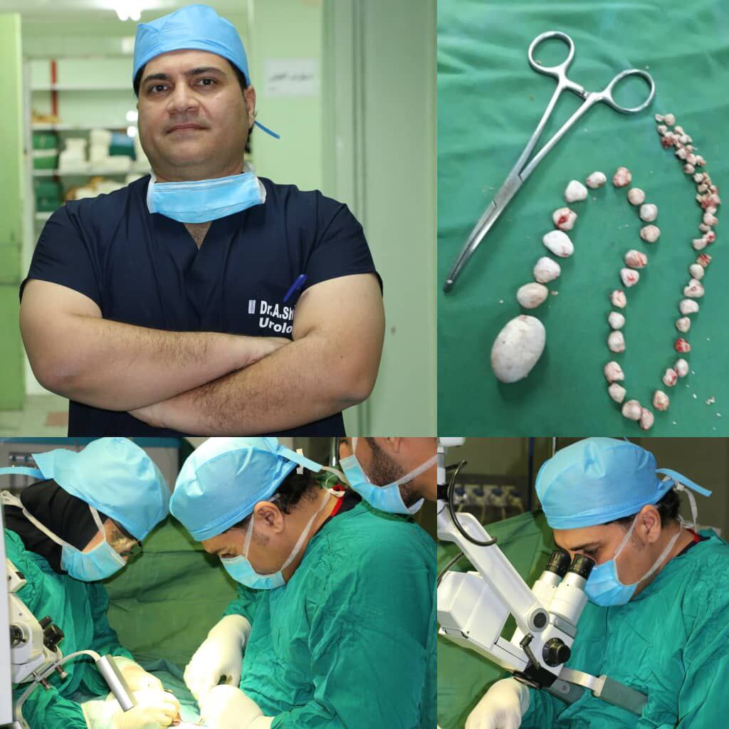 خارج کردن ۵۰ سنگ کوچک و بزرگ از مثانه یک بیمار میانسال در یک عمل جراحی – شوشتر (خوزستان)