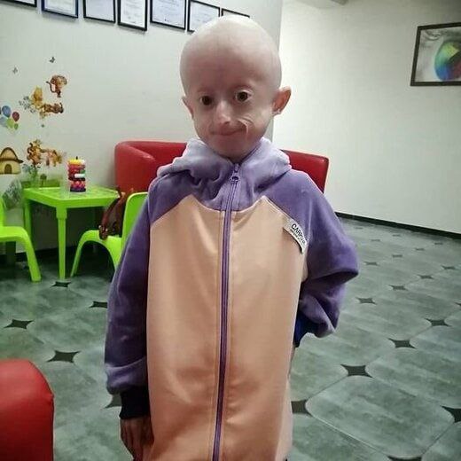 دختر ۱۰ ساله اوکراینی بر اثر پیری زودرس درگذشت