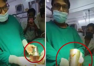 تعجب پزشکان هندی از کشف لیوان فولادی در معده یک مرد