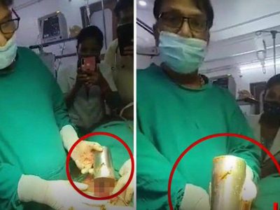 تعجب پزشکان هندی از کشف لیوان فولادی در معده یک مرد
