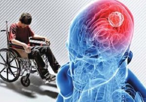 روند افزایشی بیماری ام اس در آذربایجان شرقی و کاهش سن ابتلا