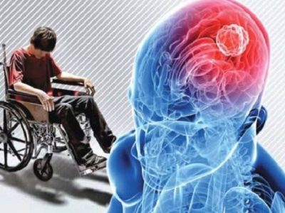 روند افزایشی بیماری ام اس در آذربایجان شرقی و کاهش سن ابتلا