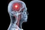 سکته مغزی؛ افزایش تصاعدی و چالش اطلاع رسانی