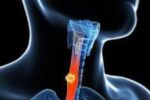 رفلاکس معده؛ علل، علائم و راهکارهای درمانی