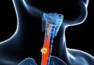 رفلاکس معده؛ علل، علائم و راهکارهای درمانی